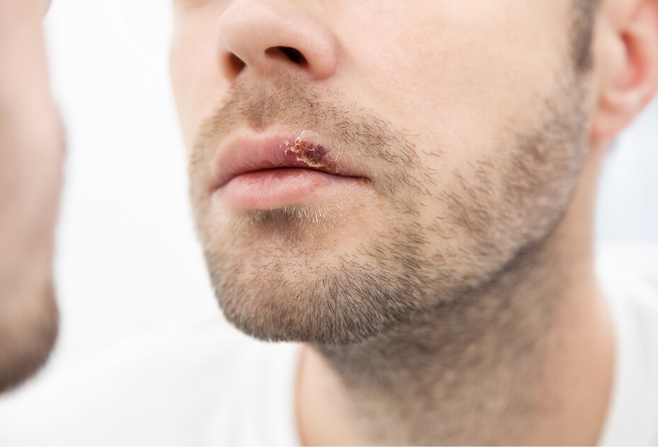 cold sores